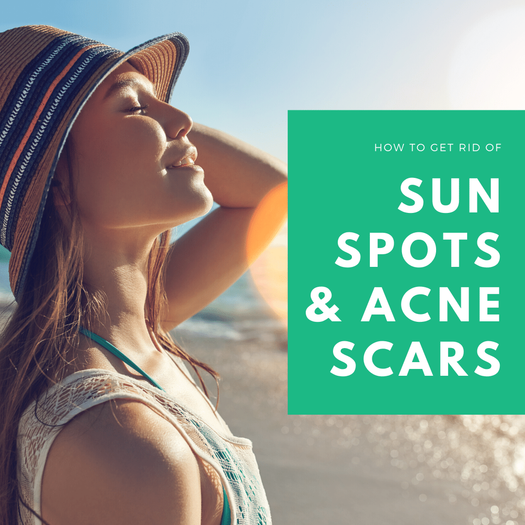 How to Get Rid of Sun Spots & Acne Scars