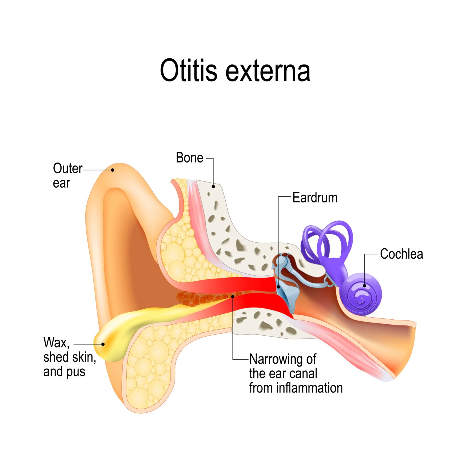 diagram of otitis externa