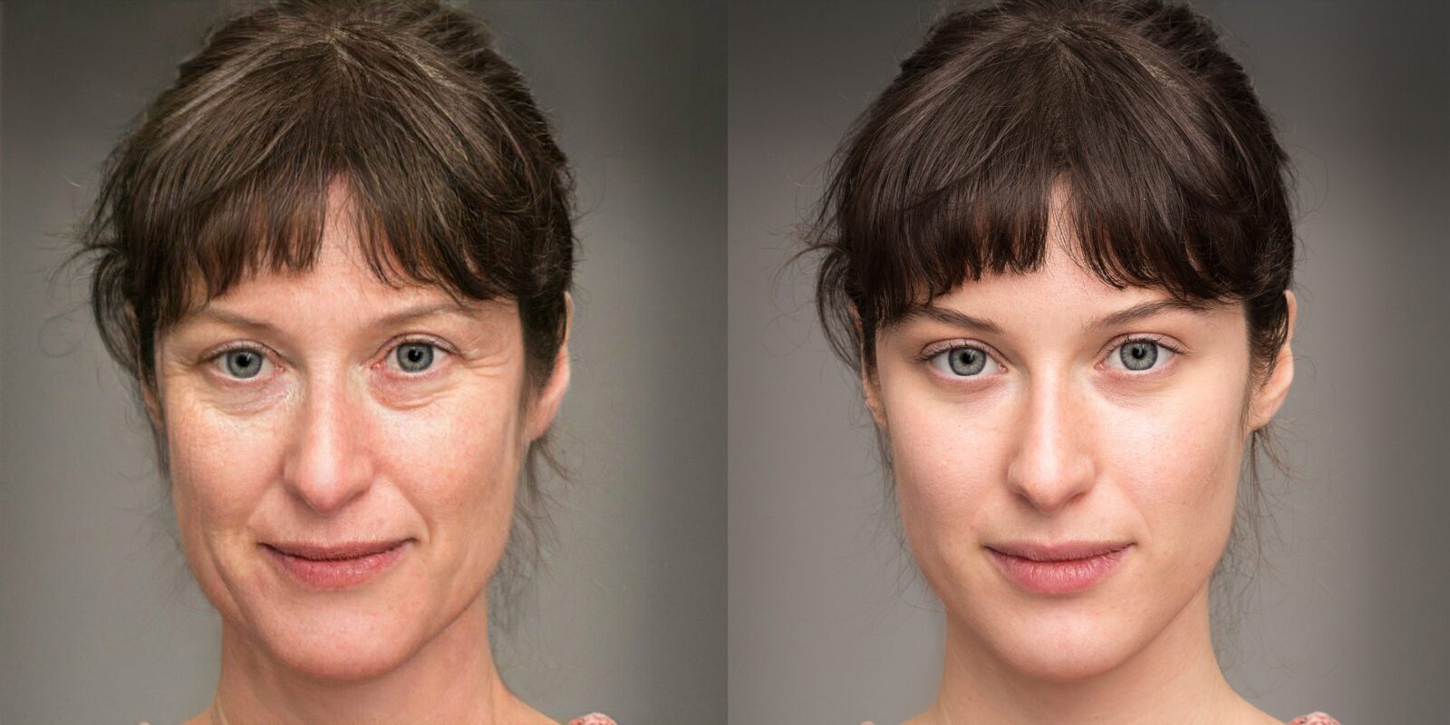 before and after laser treatment wrinkles