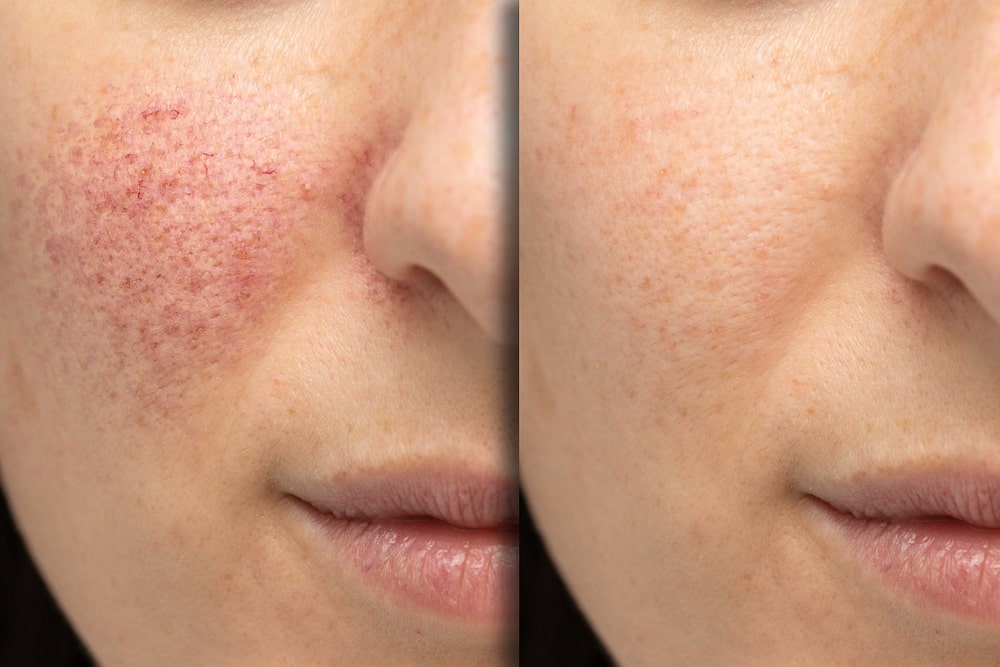 before and after laser treatment pigmentation