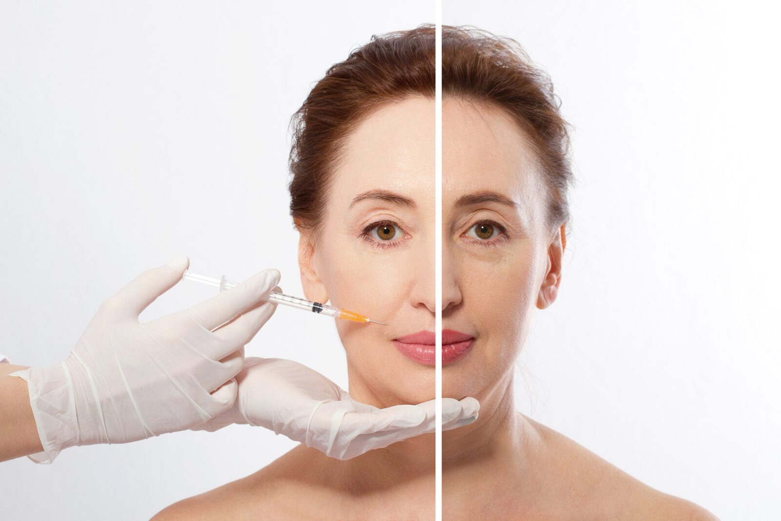 before and after dermal fillers anti-aging