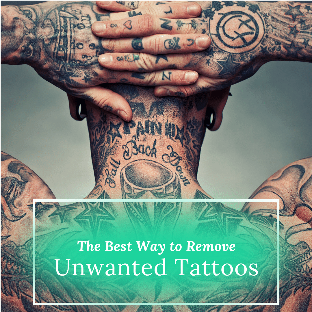 The Best Way to Remove Unwanted Tattoos