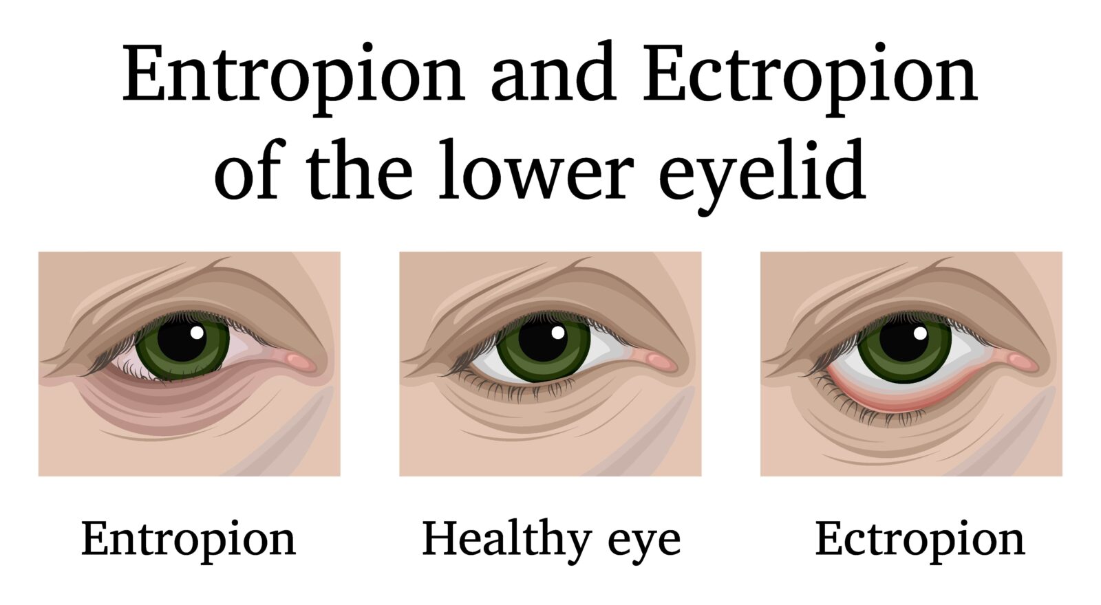  ectropion and entropion of the lower eyelid
