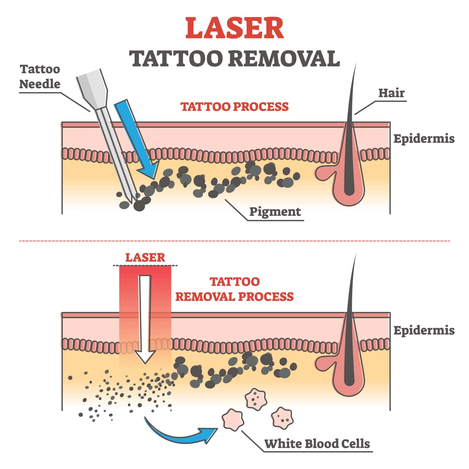 laser tattoo removal process