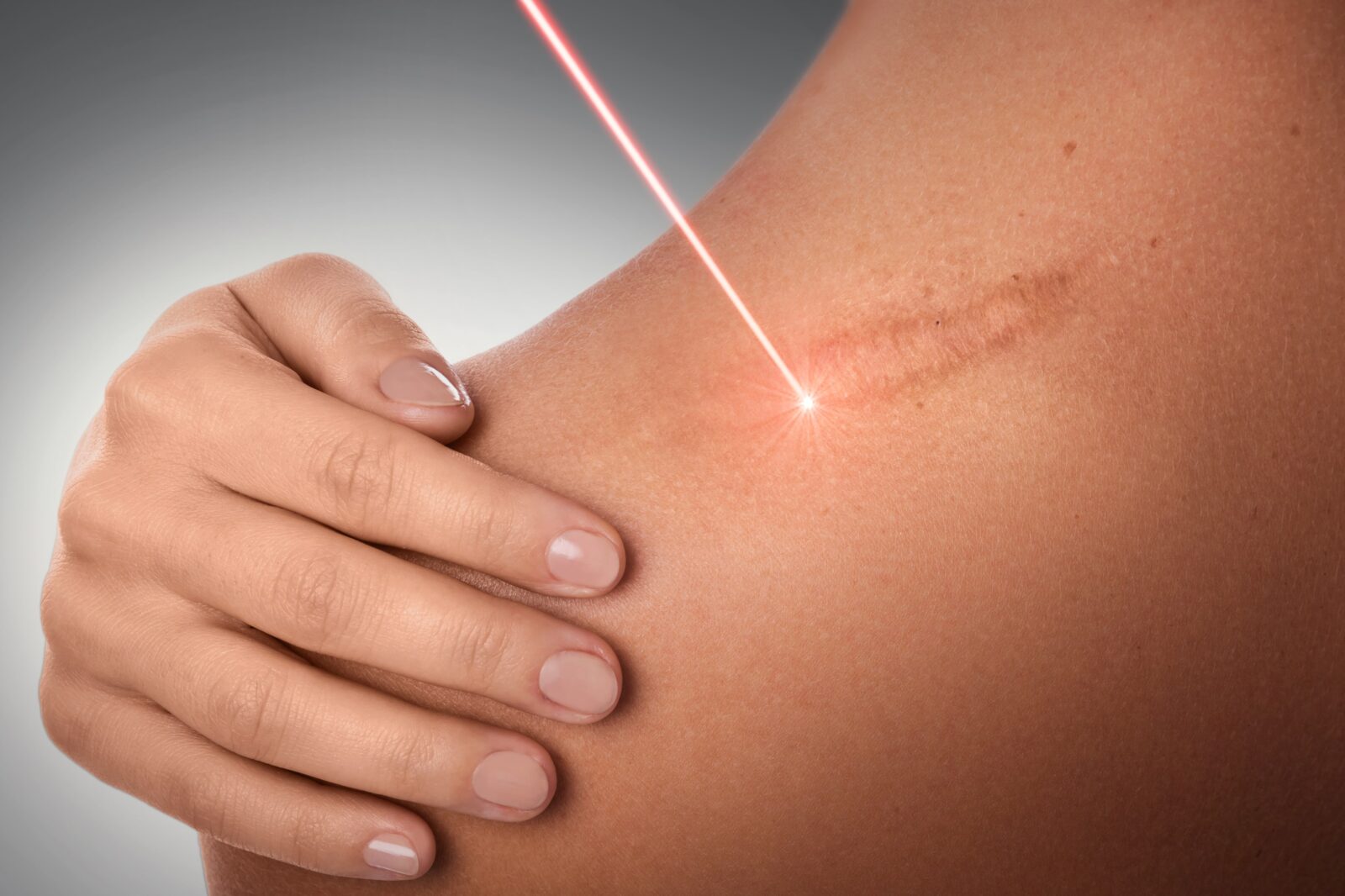 laser beam being used to remove shoulder scar
