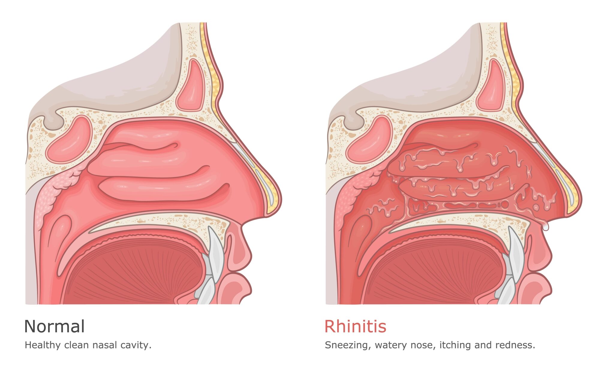 What You Need to Know About Nasal Allergies | Annapolis and Severna ...