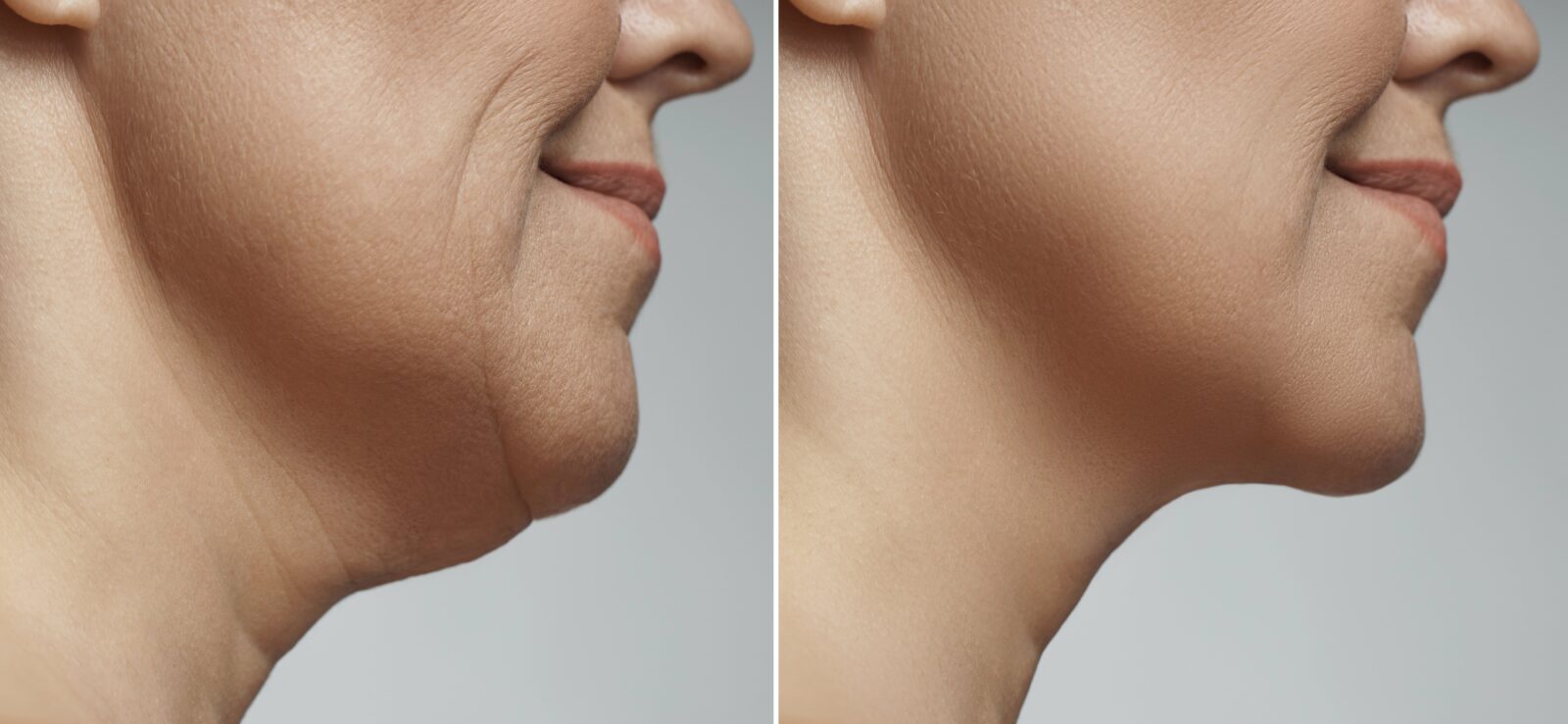 before and after neck lift