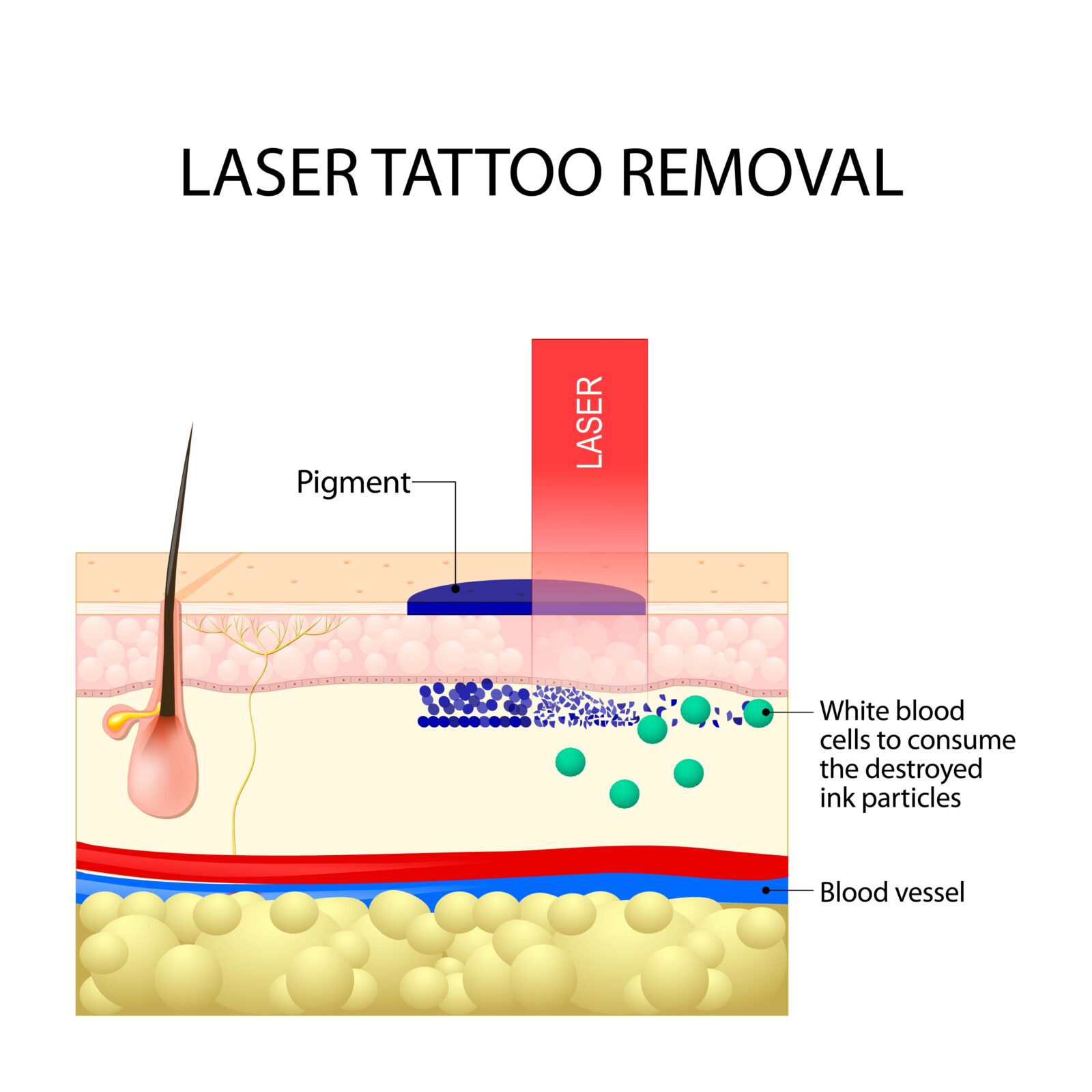 Laser tattoo removal. Dark ink absorb light and break down. White blood cells to consume the destroyed ink particles and carry them to the liver.