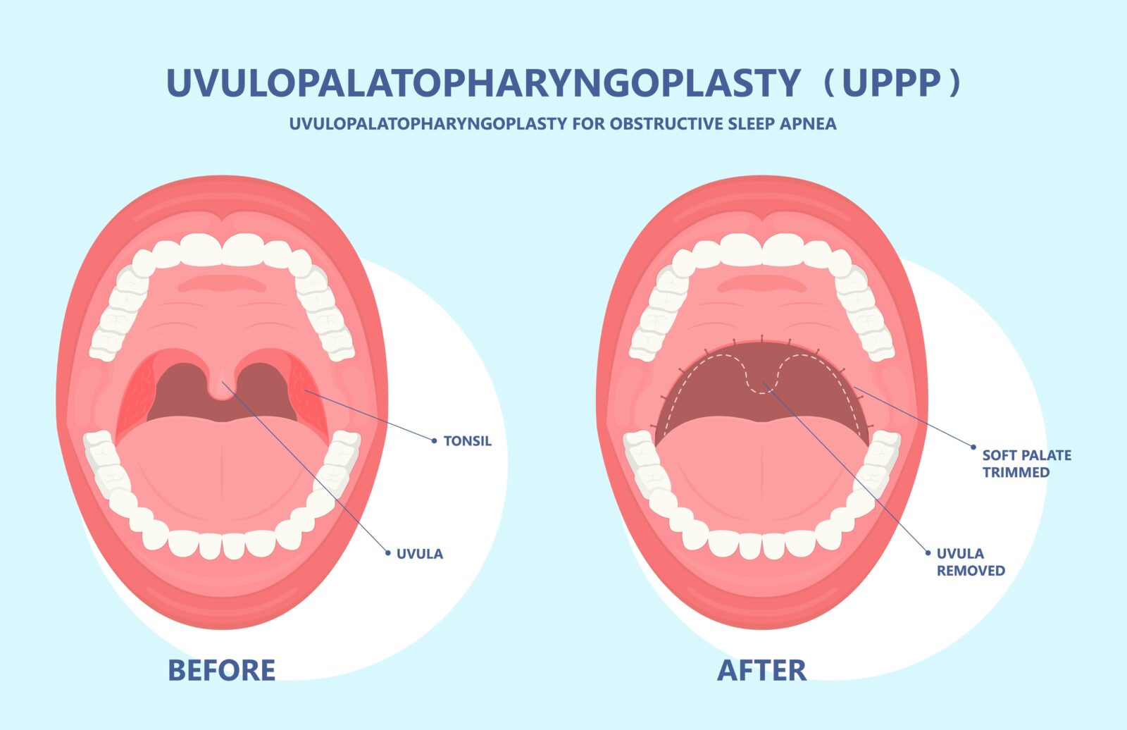 UPPP laser assisted sleep apnea OSA surgery treat tonsil uvula Uvulo Palato Pharyngo Plasty Snoring Oral Excision throat remove mouth Jaw airway study block Nasal obstruction