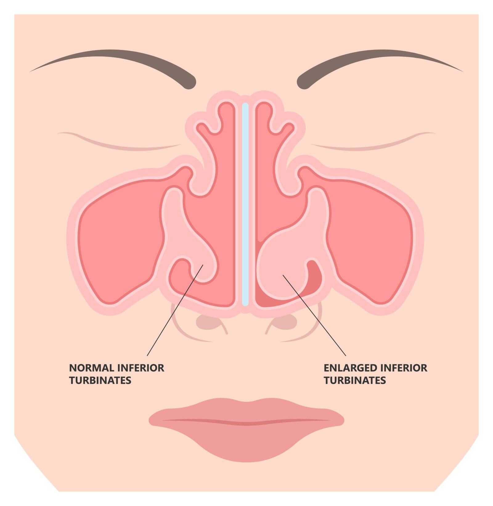 Deviated Ear ENT CPAP nose stop apnea block laser nasal RAVOR RFVTR runny sinus sleep treat airway concha device mucous polyps septal septum throat tissue airflow air way bullosa drip allergic
