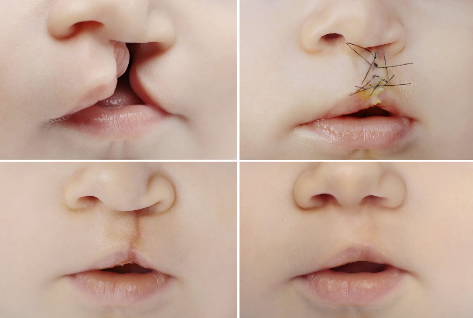 surgical repair of cleft lip and palate
