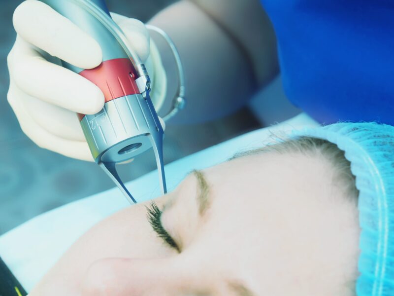 Caucasian woman patient on laser procedure skin resurfacing in aesthetic medicine