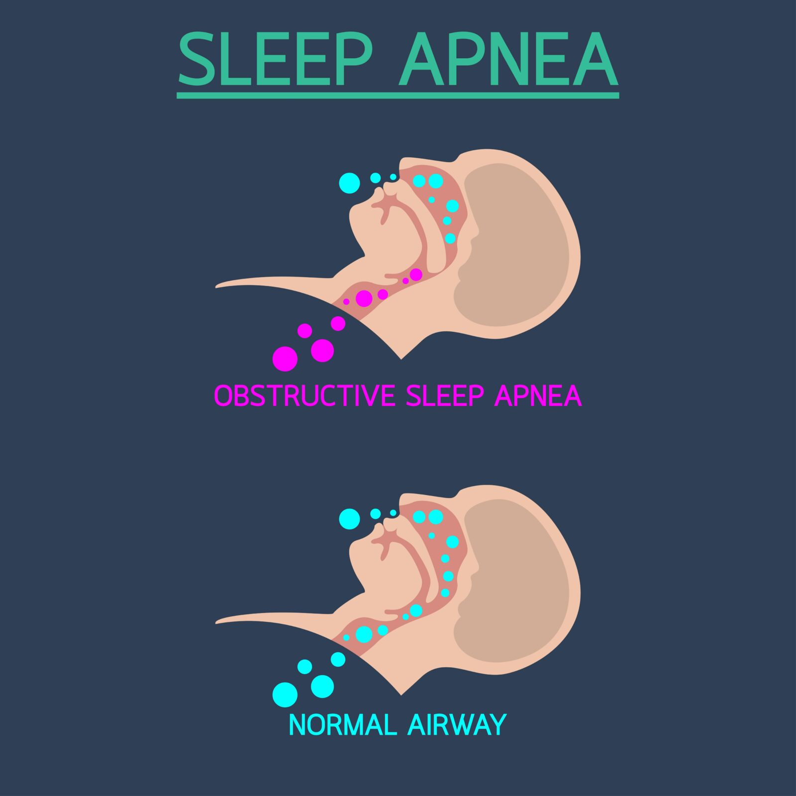 obstructive sleep apnea vs. normal airway
