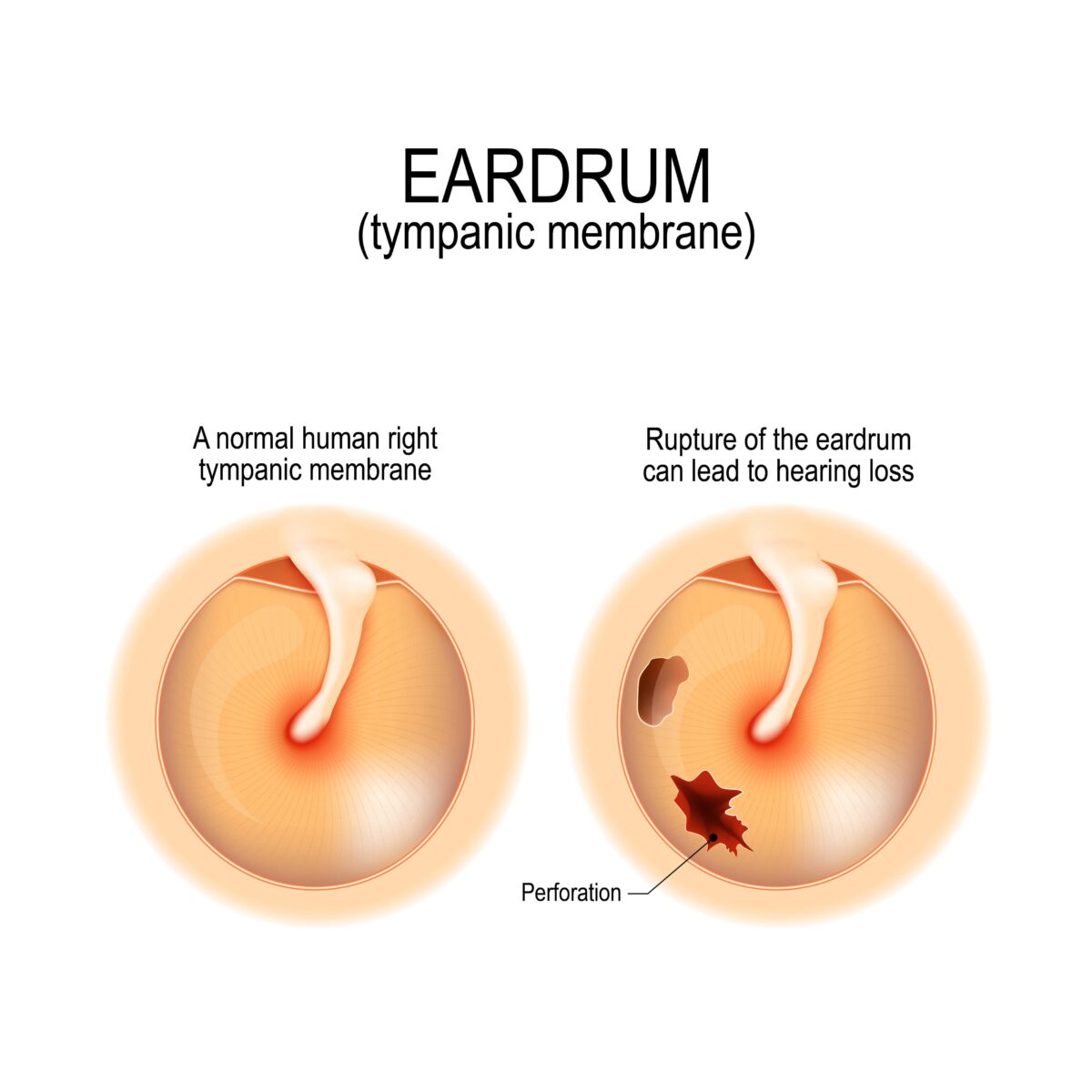 What Causes Your Eardrum to Rupture? Annapolis and Severna Park, MD