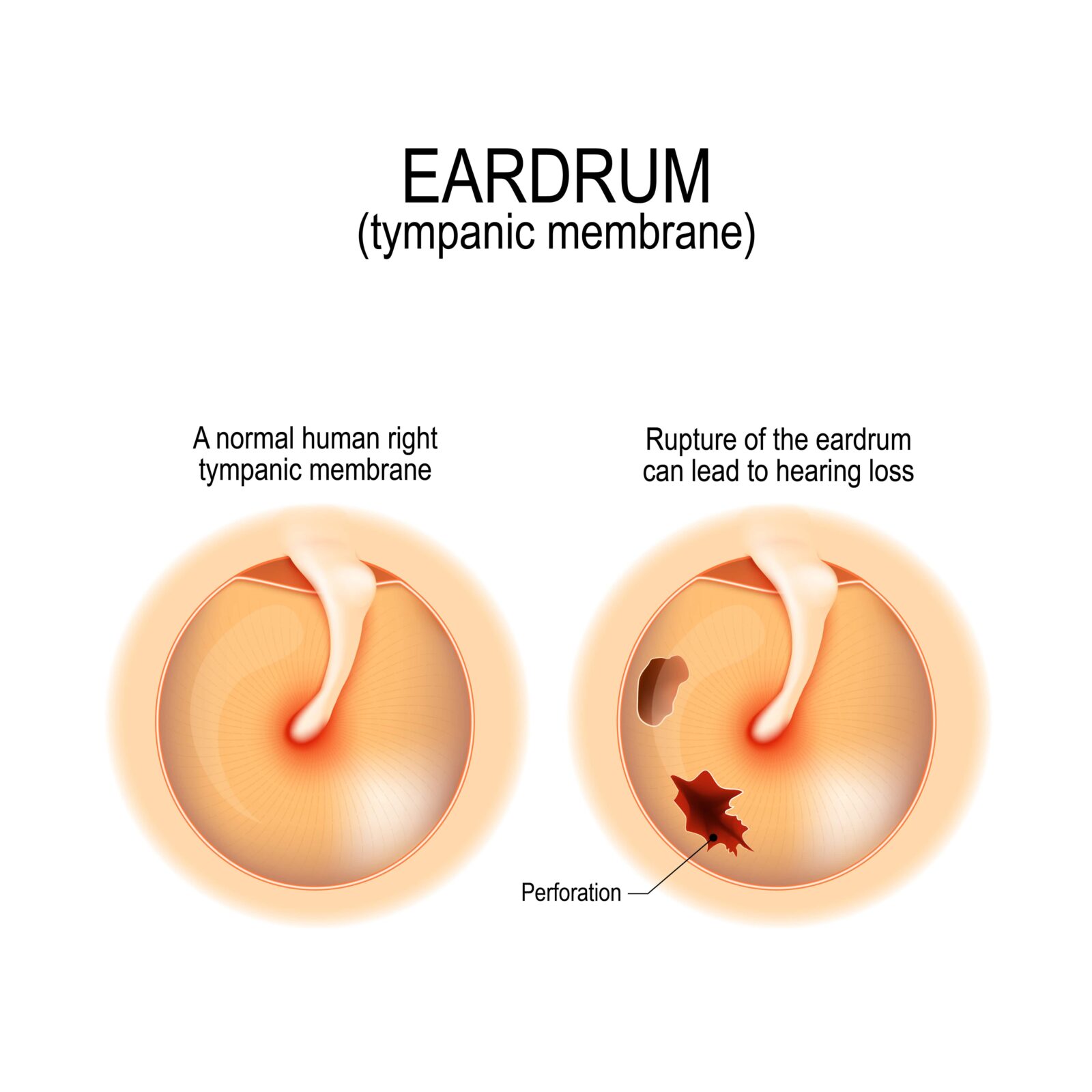Ruptured eardrum. Anatomy of the humans eardrum. Healthy and perforated tympanic membrane. illustration for medical, science, and educational use