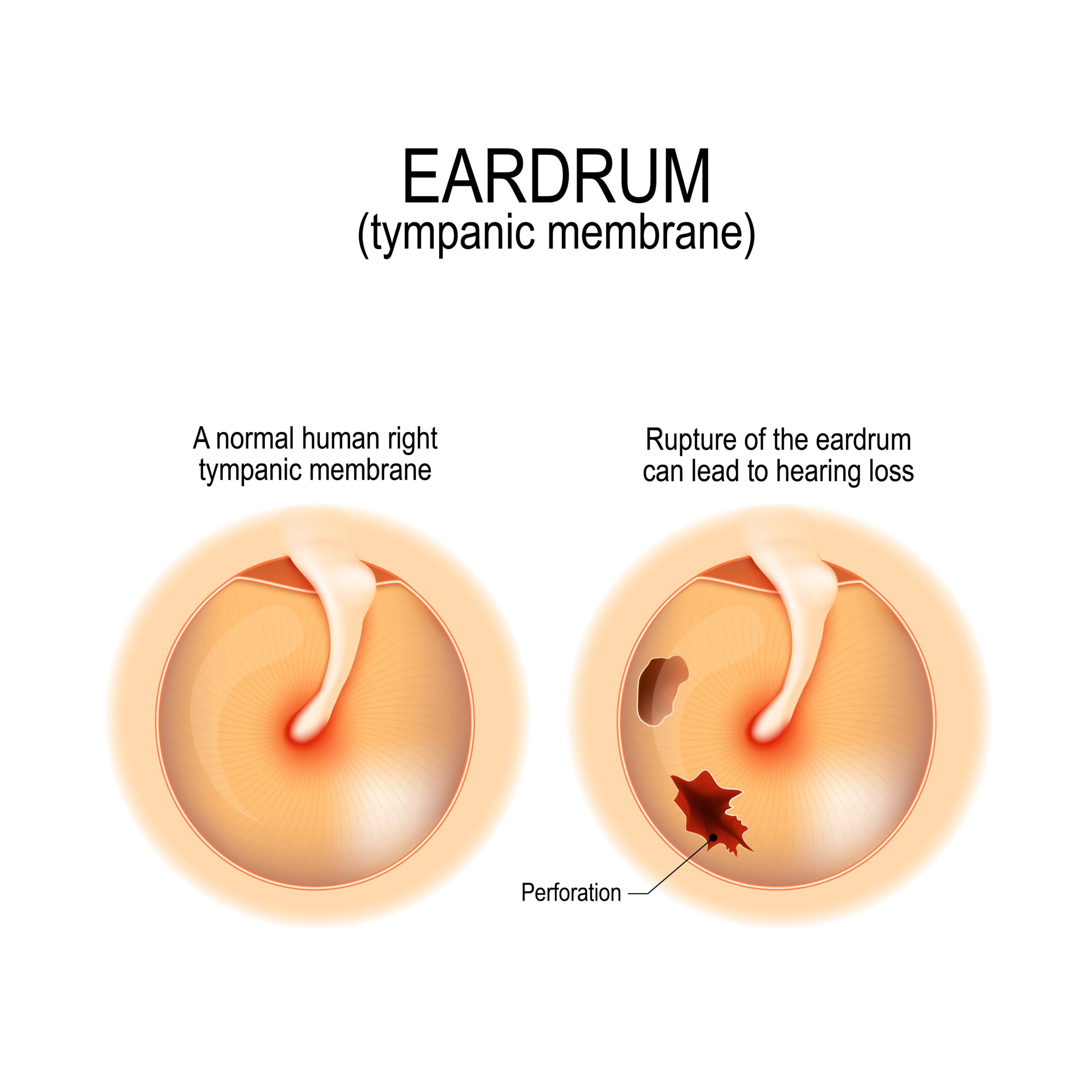 Perforated Ear Drum