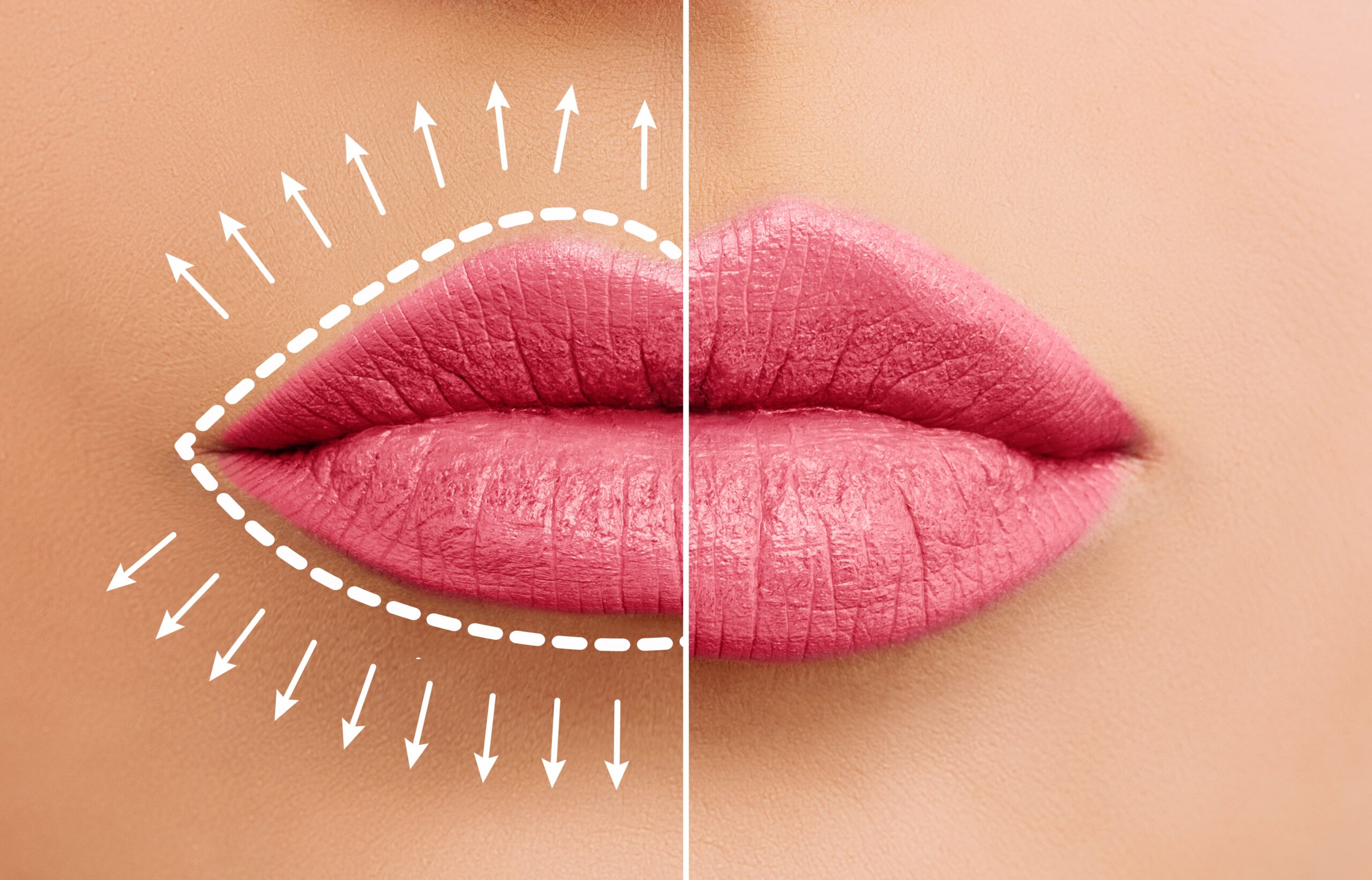 Lip Fillers: Achieving Natural and Beautiful Lip Enhancements | Annapolis  and Severna Park, MD