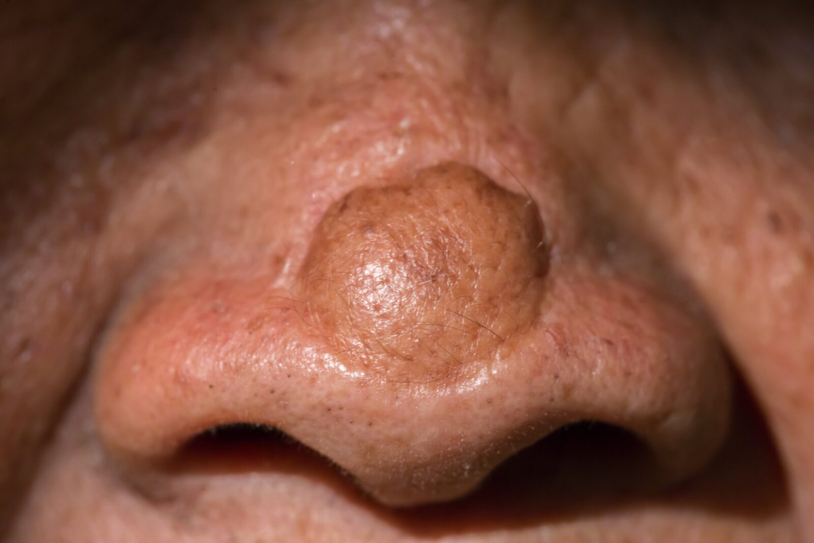 Zooming closeup view of healed free flap surgical reconstruction of nasal tip after diagnosis to basal cell cancer on patient ' s facial skin in a follow up day at a modern local rural hospital