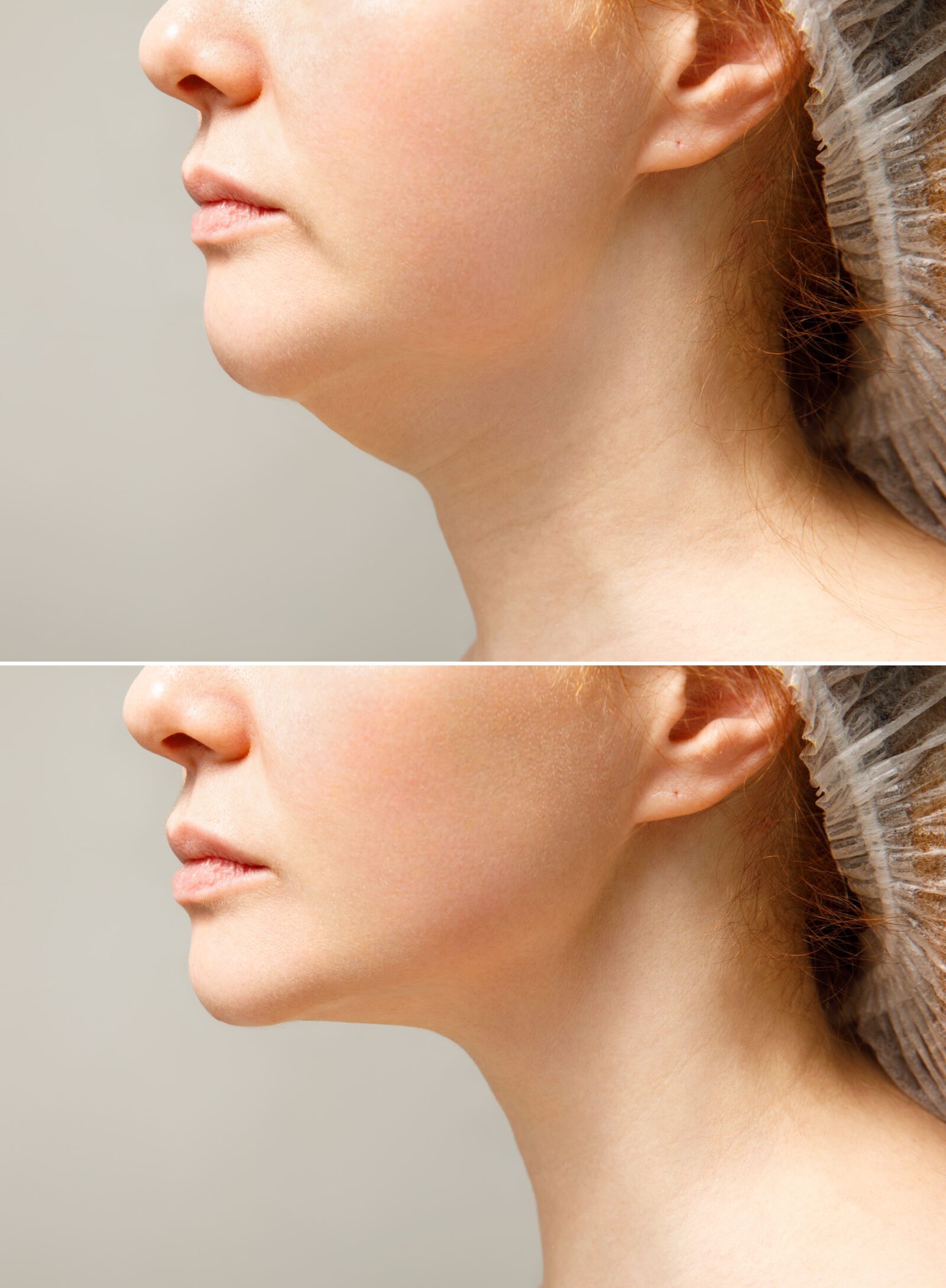 Female double chin before and after correction. Correction of the chin shape liposuction of the neck. The result of the procedure in the clinic of aesthetic medicine.