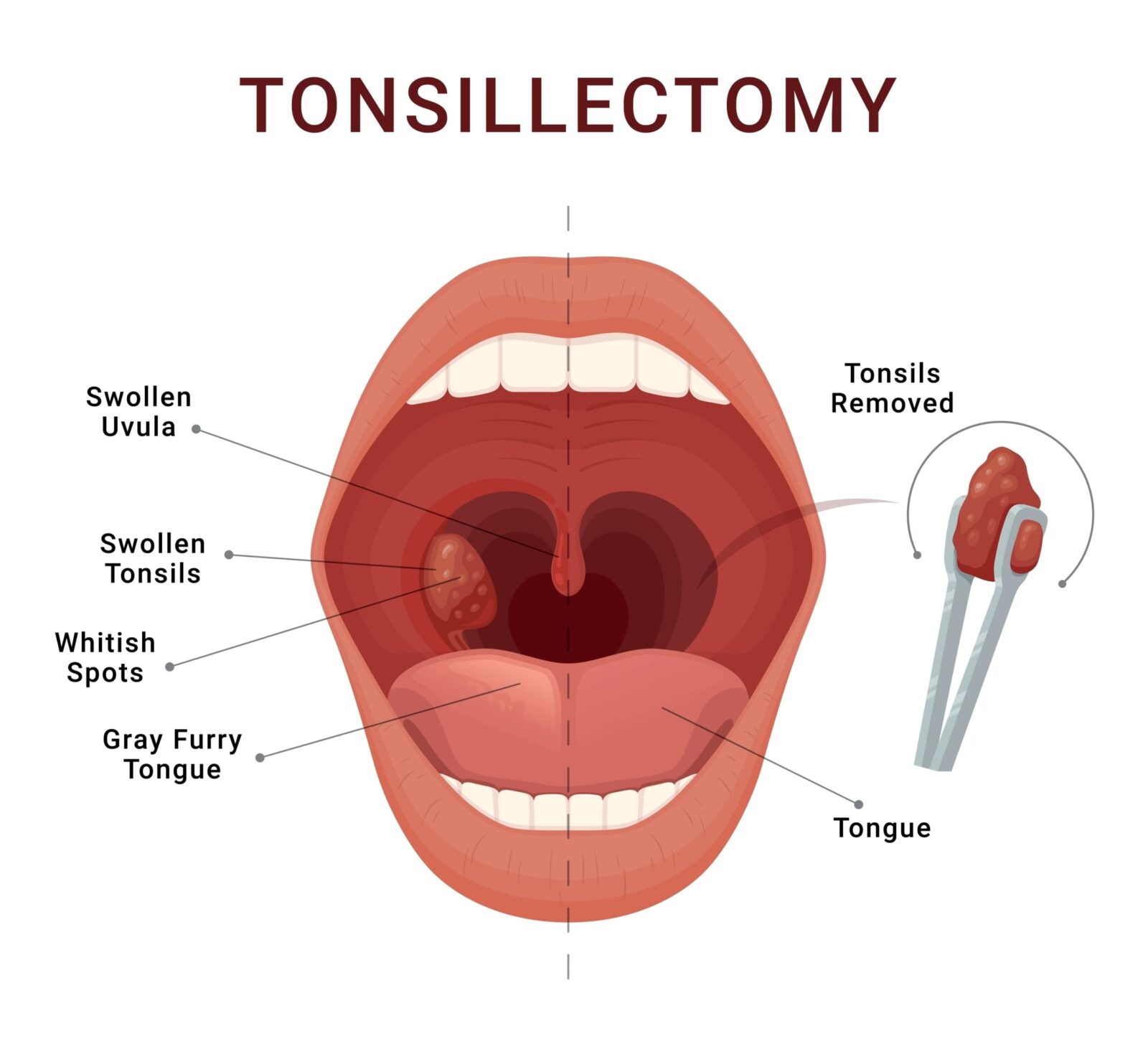 Tonsillectomy scheme removal of palatine tonsils acute pharyngitis vector isometric illustration. Open human mouth inflammation bacterial disease adenoids infection breath blockage medical infographic
