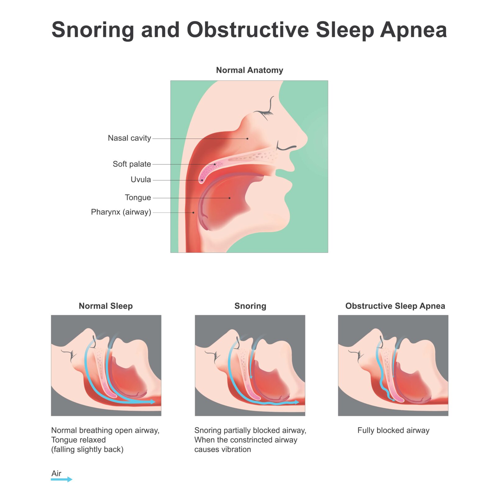 snoring and obstructive sleep apnea diagram