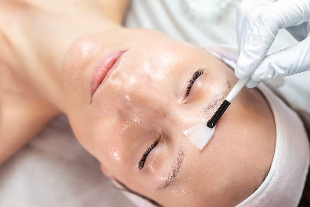 Chemical Peels for Acne-Prone Skin: How They Work