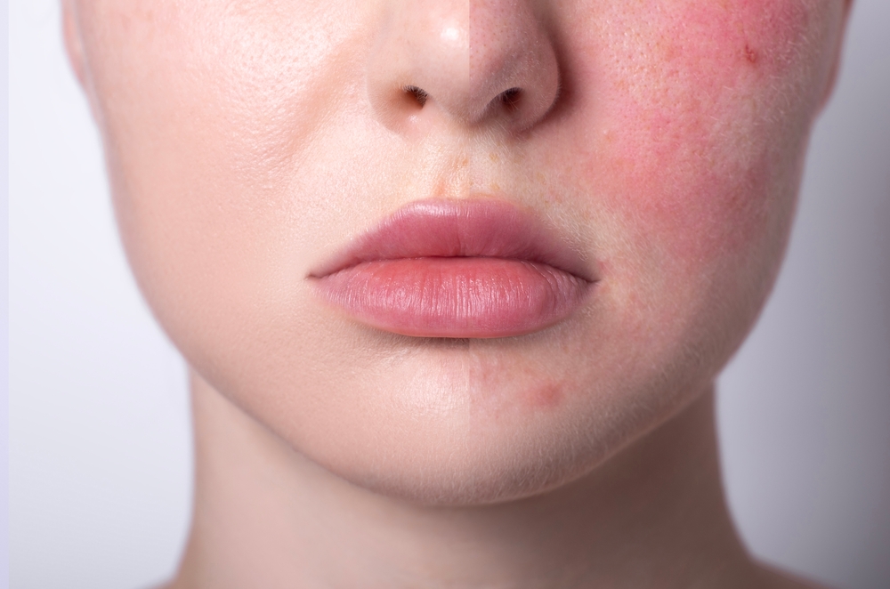 Managing Sensitive Skin: Medispa Treatments and Care Tips