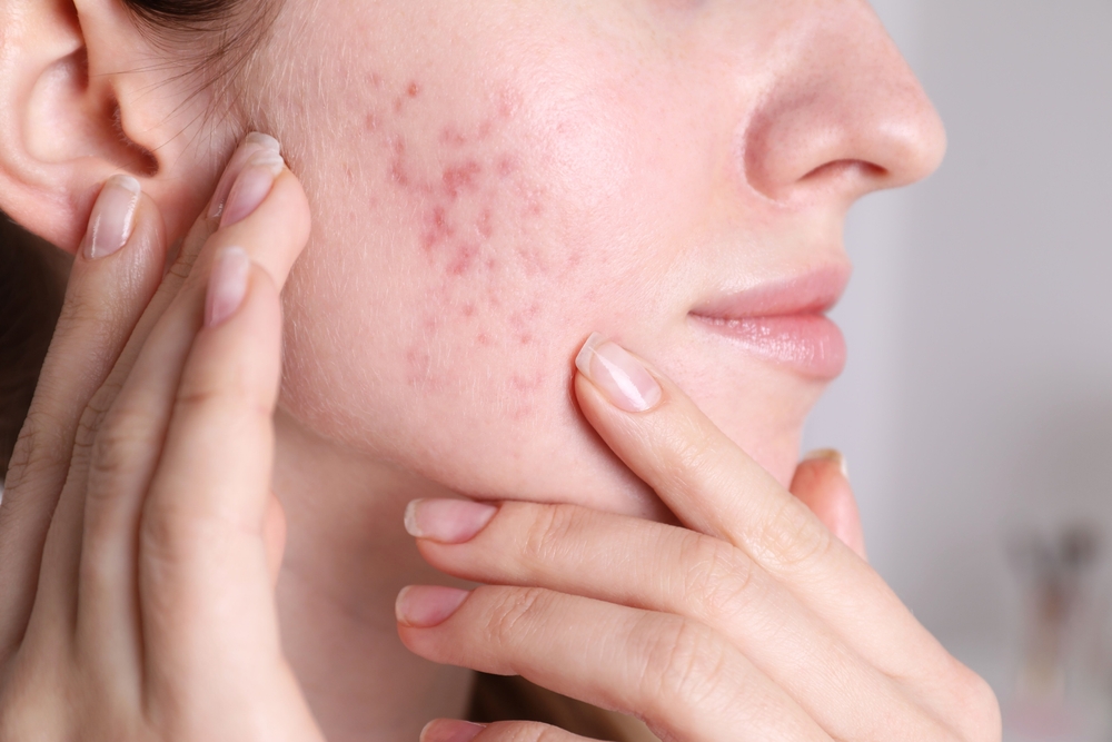 Acne Scars