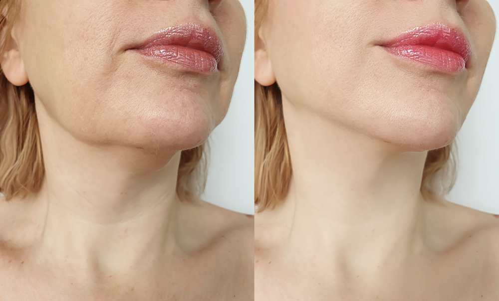 How Liposuction Can Complement a Facelift for a More Sculpted Look