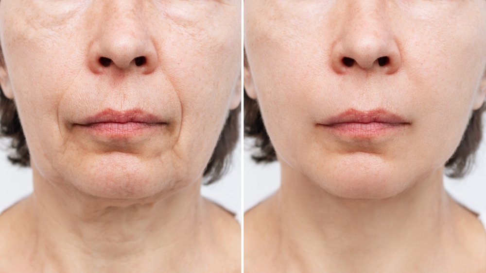 What to Expect When Getting a Neck Lift: The Benefits Beyond the Face