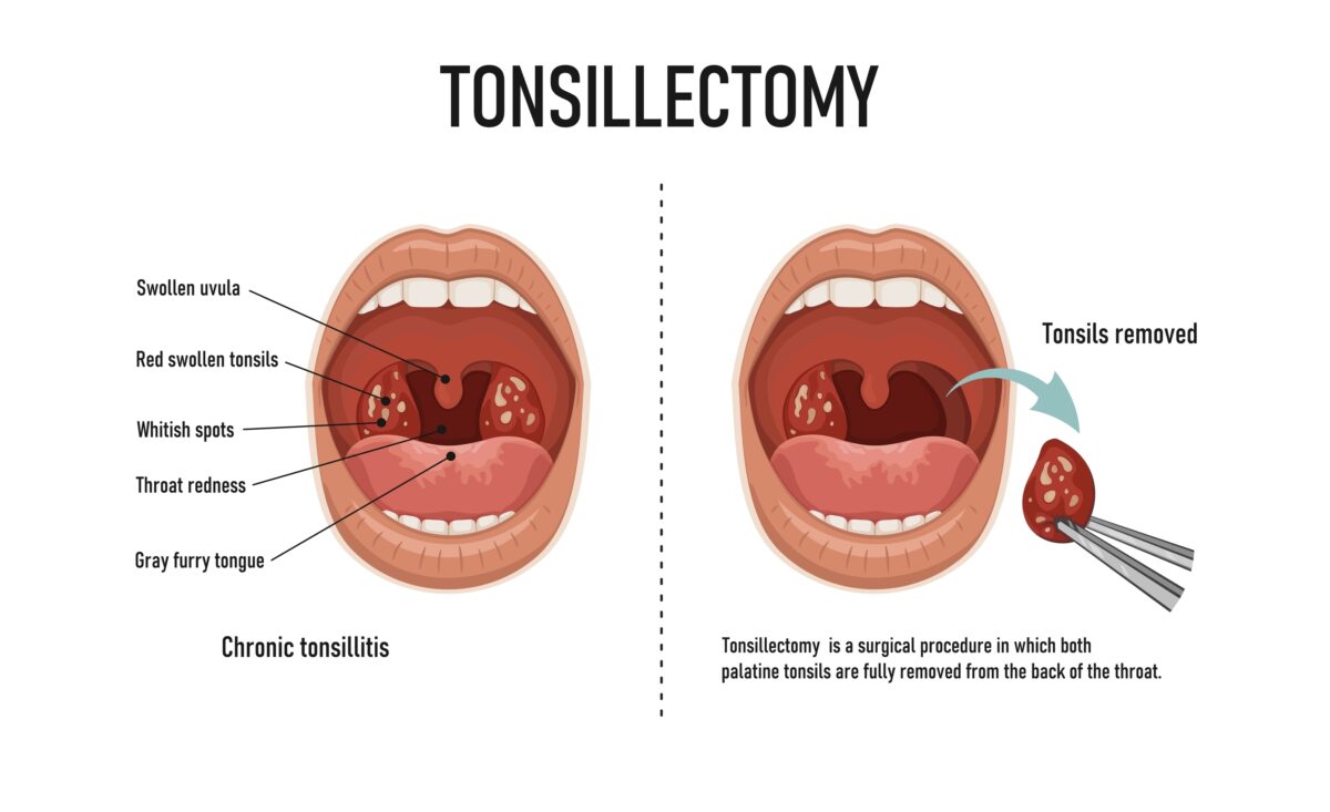 tonsillectomy treatment