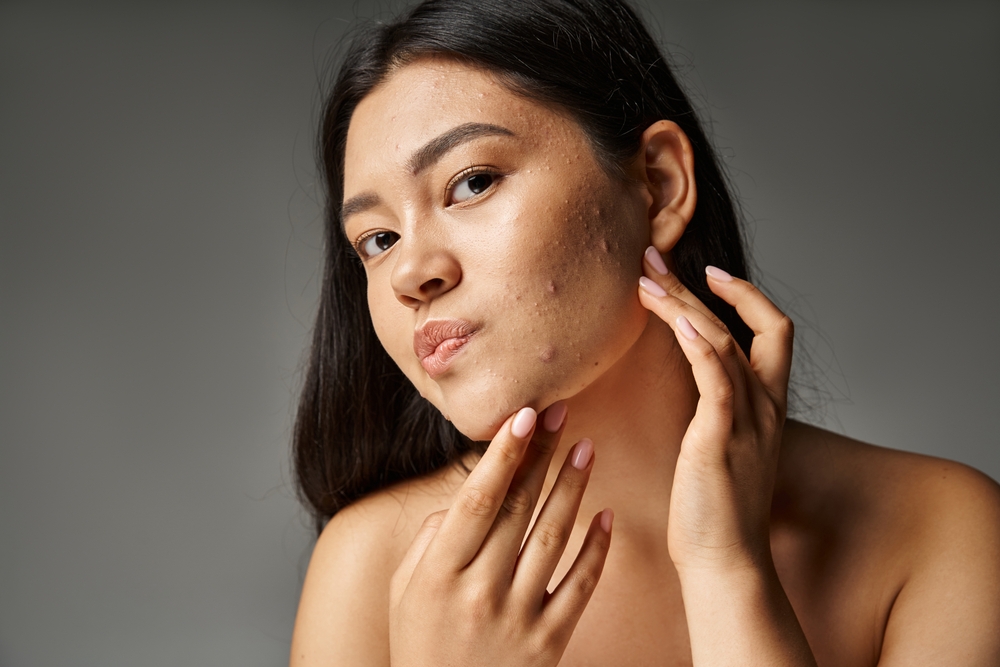 Chemical Peels for Acne-Prone Skin: How They Work