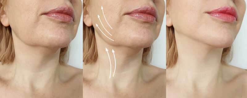 Choosing Between a Full Facelift and a Mini-Facelift: Which Is Right for You?