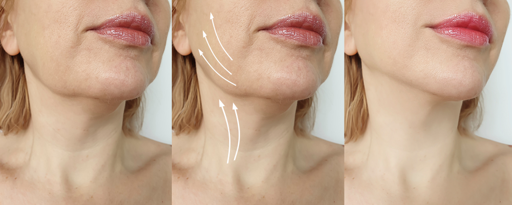 Choosing Between a Full Facelift and a Mini-Facelift: Which Is Right for You?