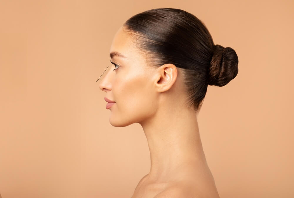 Rhinoplasty