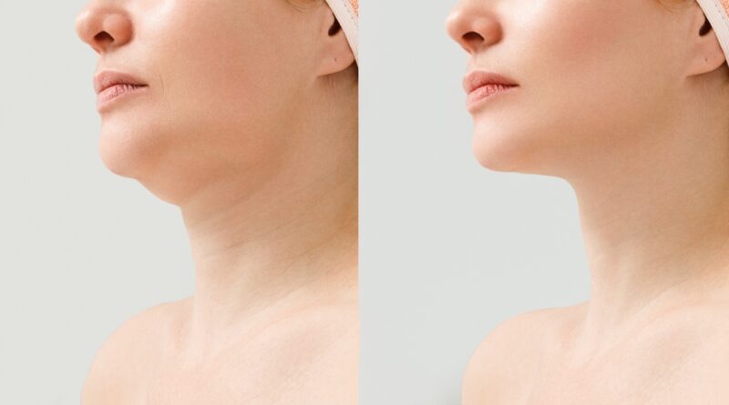 Understanding the Impact of a Neck Lift on Facial Contours and Skin Tightness