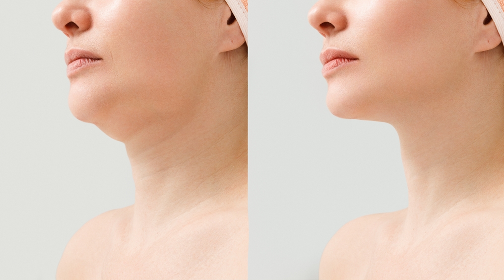 Understanding the Impact of a Neck Lift on Facial Contours and Skin Tightness