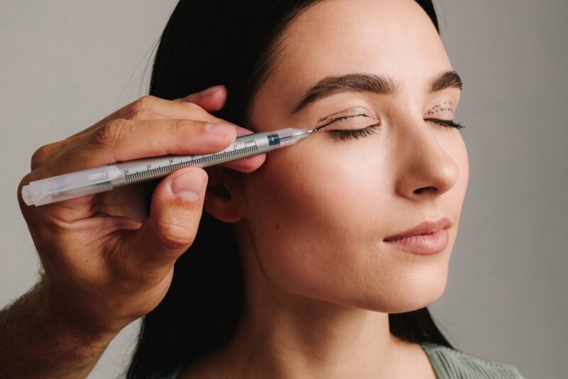 Surgeon is planning process of upper blepharoplasty with marker. Surgeon is drawing marking lines on eyelid of patient to have accurate operation