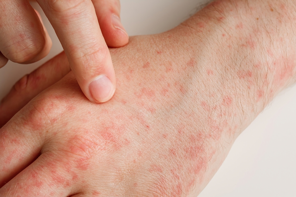 Hands,With,Allergy,Reaction,From,Taking,Medicines,Or,Wrong,Diet