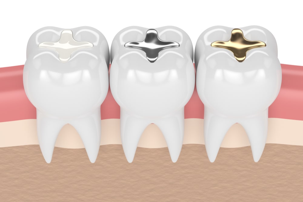 3d render of teeth with gold, amalgam and composite