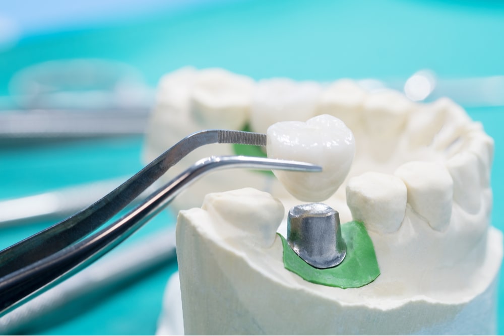 Implan model tooth support fix bridge