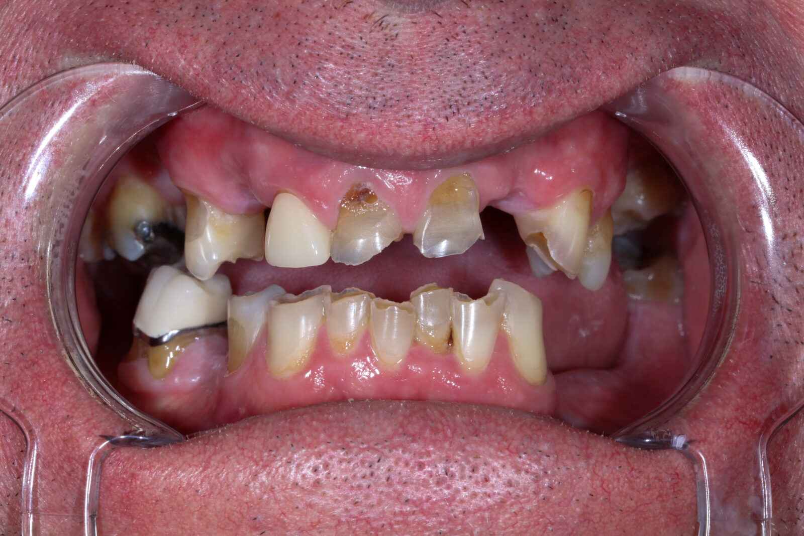 Before treatment: broken and failing teeth, real Bloomfield Dental patient