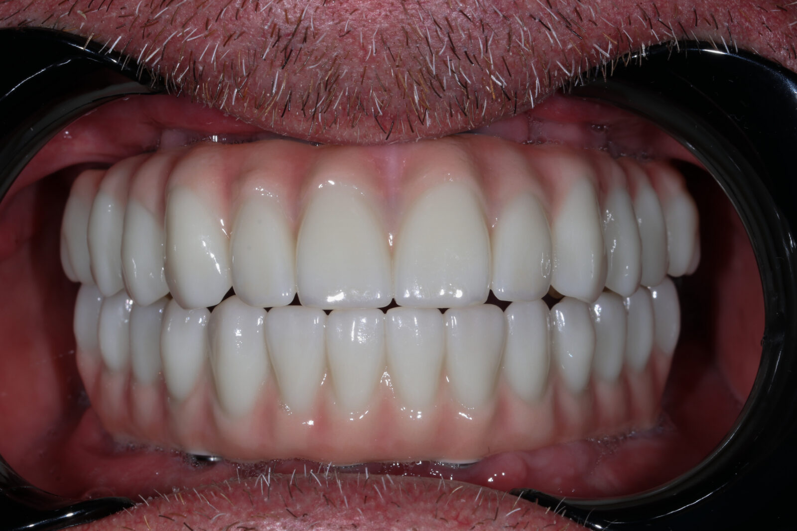 After treatment: new upper and lower teeth, same Bloomfield Dental patient