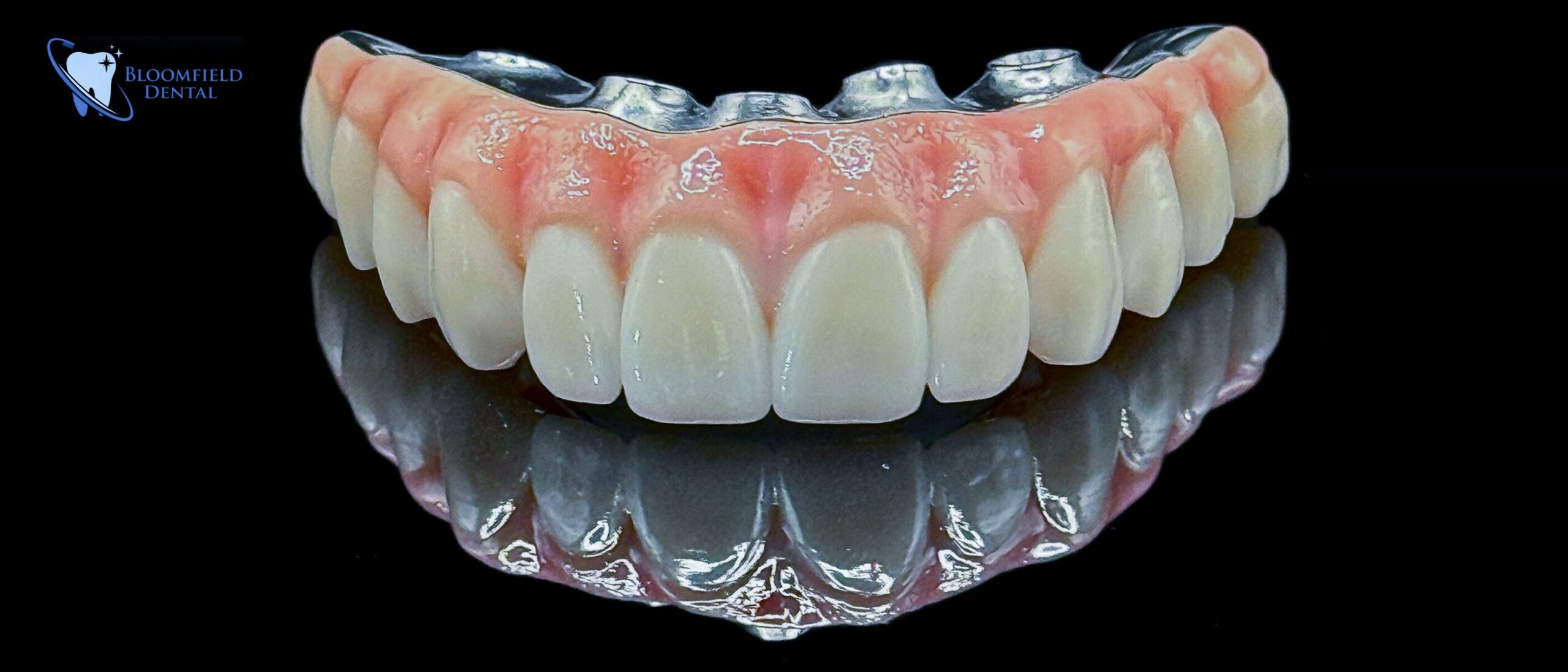 Custom full arch prosthesis designed and fabricated for a Bloomfield Dental patient