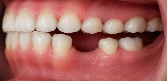 Missing lower molar space shortly after extraction, with the neighboring teeth still in their original position