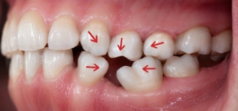 The same missing tooth space six months later, with arrows showing the neighboring teeth tipping and drifting into the gap