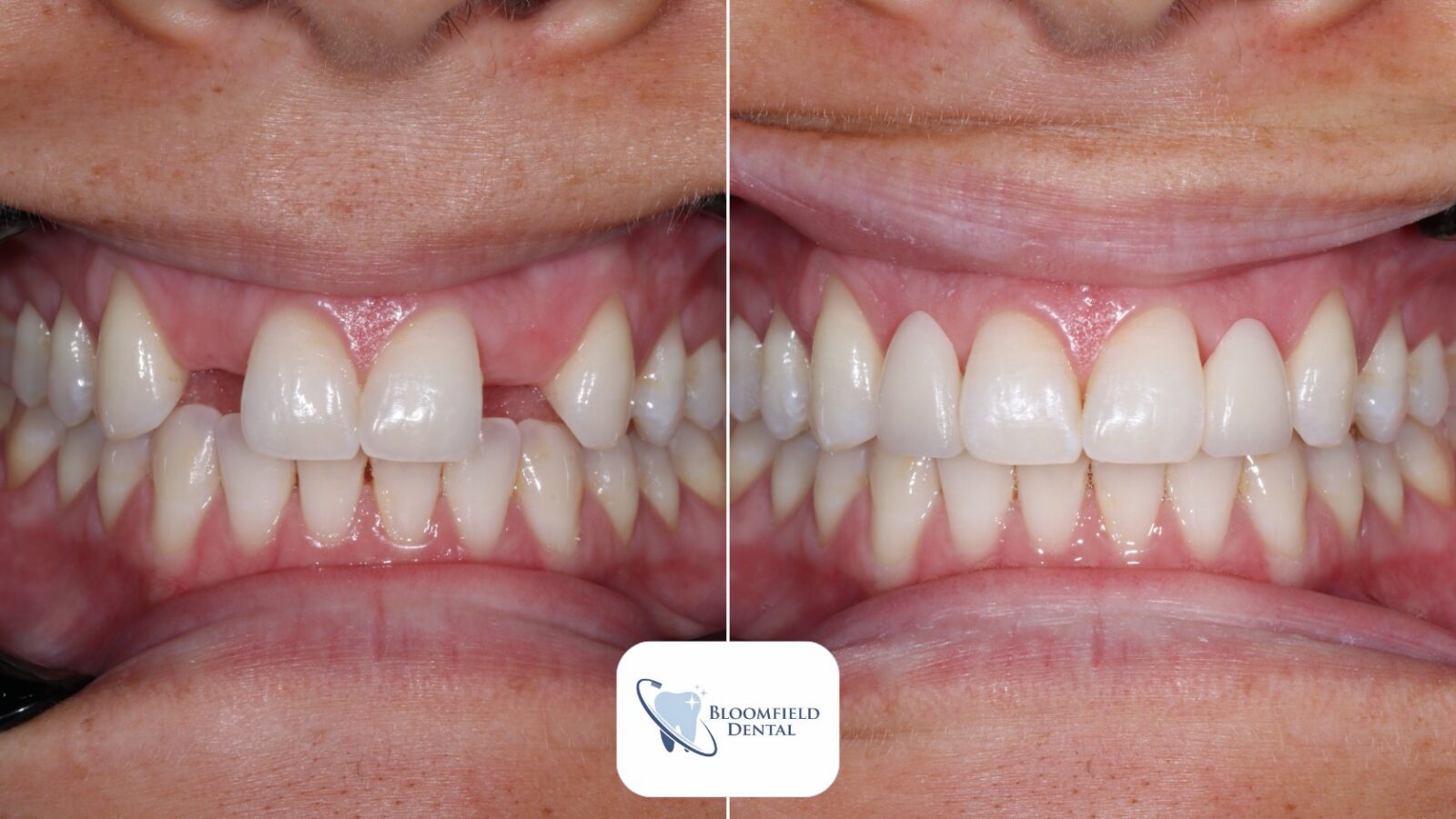 Before and after: missing front teeth replaced with dental implants at Bloomfield Dental