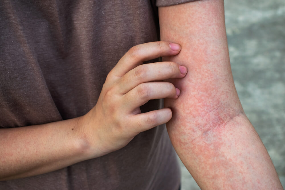 Allergy is a red rash on the body