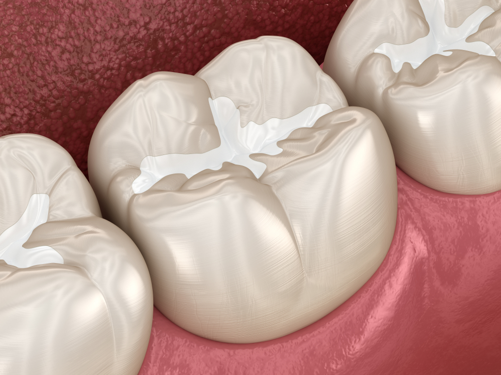 An example of Composite Tooth-Colored fillings on teeth