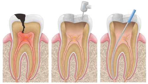 First three steps of Root Canal